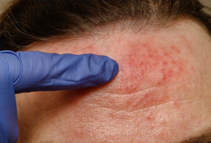 Study Shows NEO400 Has Therapeutic Effect On UV-Induced Skin Damage
